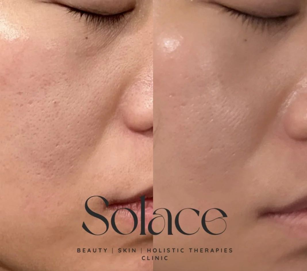 Before and after close-up images of a person's cheek showing improved skin texture, with the text "Solace Beauty Skin Holistic Therapies Clinic" at the bottom.