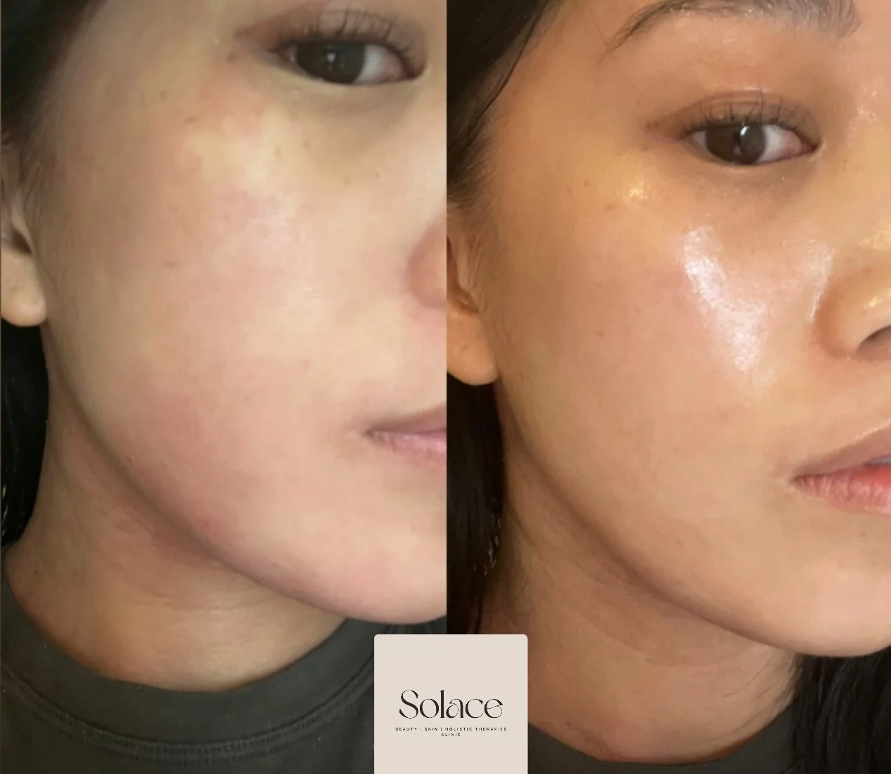 Side-by-side comparison of a woman's face showing the skin before and after skincare treatment; the left side shows dull skin with uneven tone, and the right side shows glowing, clearer skin with reduced spots.