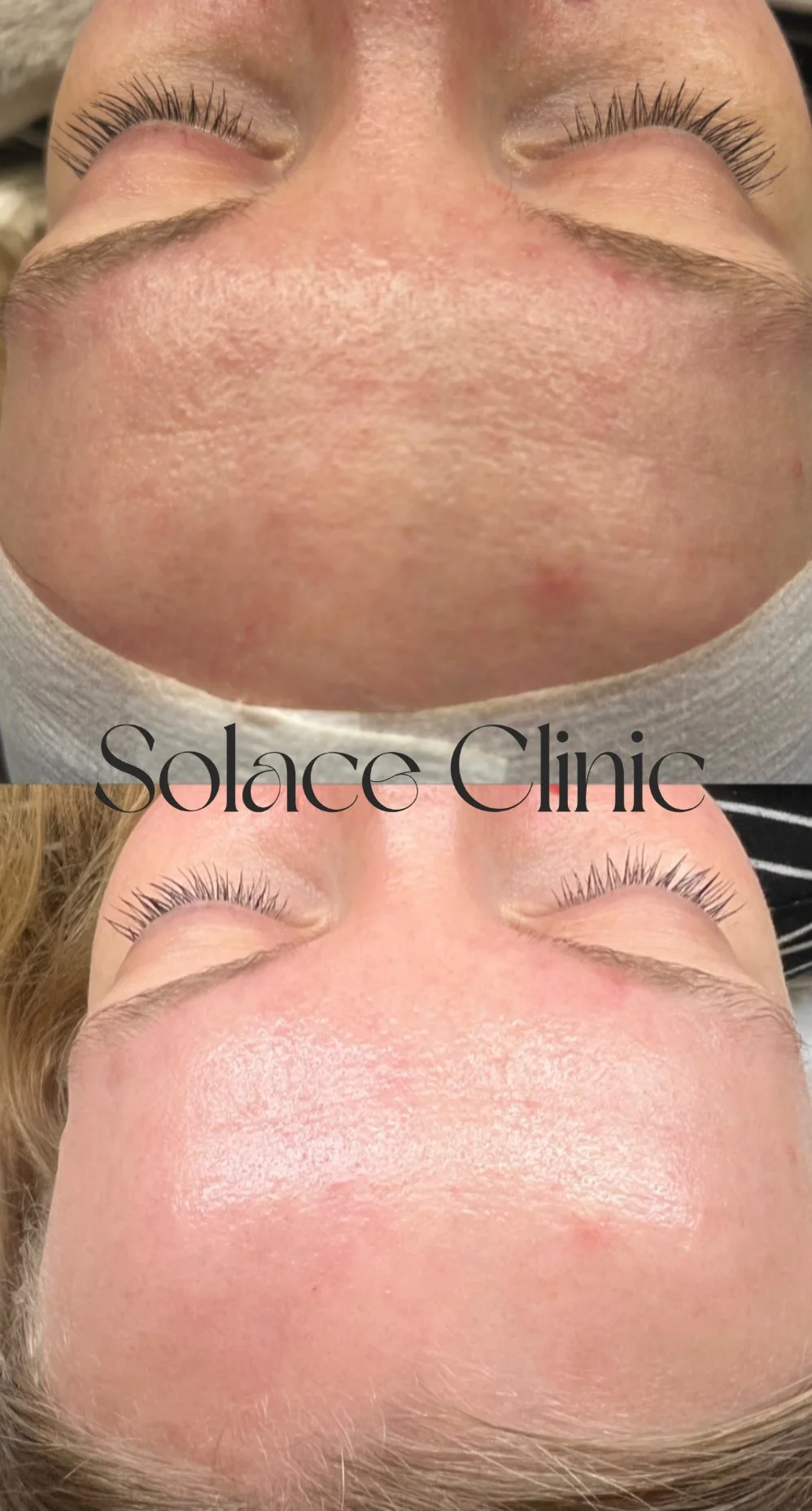 Side-by-side comparison of a person's forehead before and after skincare treatment, showing improved skin texture and reduced redness.