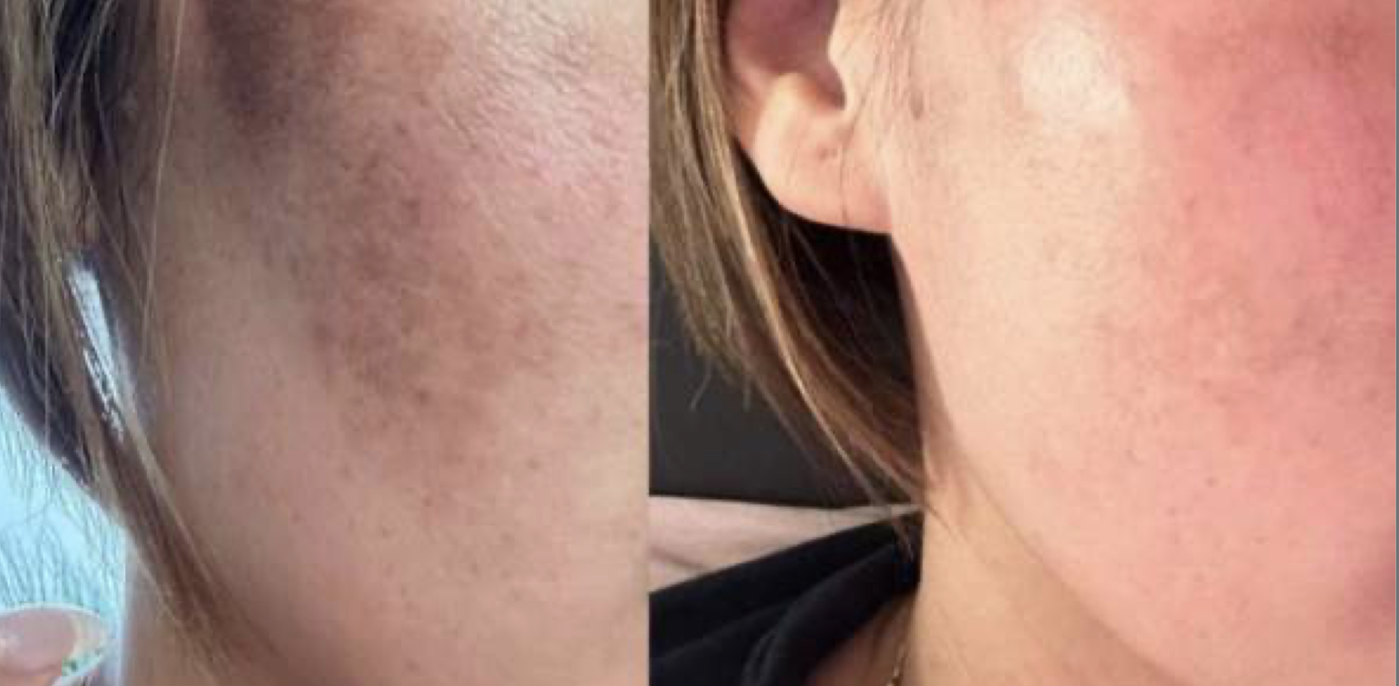 Comparison of skin showing acne scars and hyperpigmentation on the left side, and clear, smooth skin on the right side.