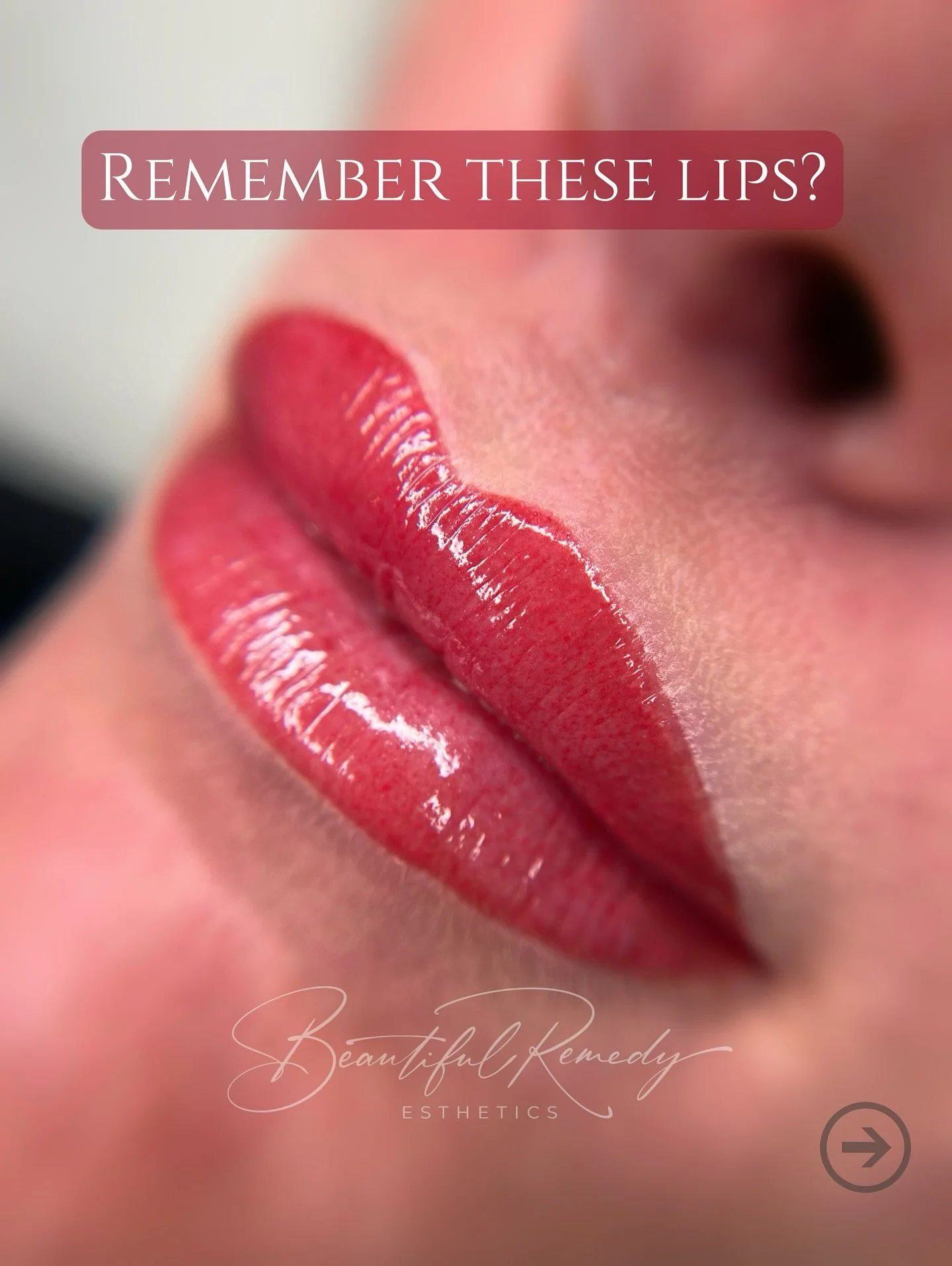 Sometimes the transition is soft and gradual &mdash; and that&rsquo;s exactly how I prefer it. 
If you&rsquo;re nervous about lip blush results, gentle is the way to go. Yes, the immediate color looks bold, but once healed, the results are natural, u