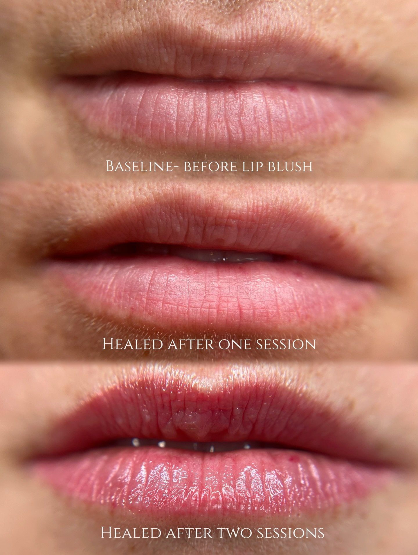 It&rsquo;s come to my attention that I need to share more healed lip blush results &mdash; because while the immediate post-treatment color is bold, beautiful, and so fun to photograph, the true magic is in the healed outcome.

This photo shows the p