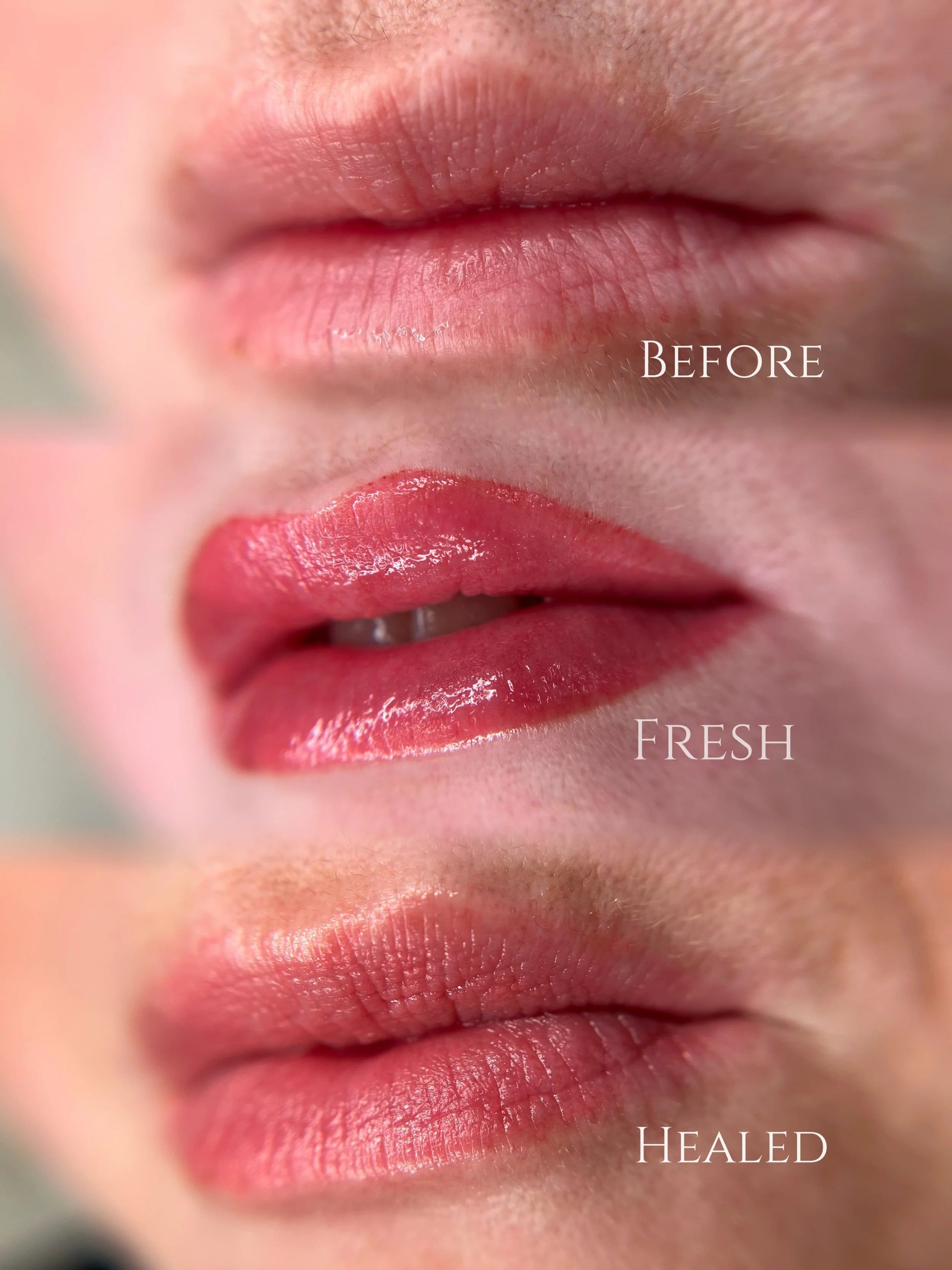 We&rsquo;ve got some touchup to do on these lips, but overall this is great first session healed results especially since she has vitiligo that has effected areas of the lips. If your lips have pigment irregularities, sun damage or scar tissue, pleas