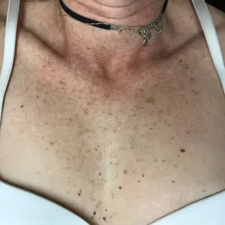 IPL skin rejuvenation treatment on the décolleté area at Sugarmoon® Salon in Canada