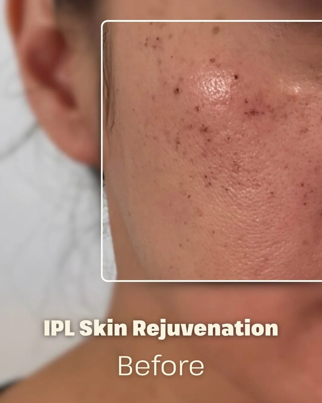 Membership Monday Glow ✨
Real results, real glow &mdash; see the power of IPL (Intense Pulsed Light) for yourself!

Swipe to see a visible reduction in dark spots after just one session 🌿
IPL helps to:

💧 Even out skin tone

☀️ Fade sun damage and 