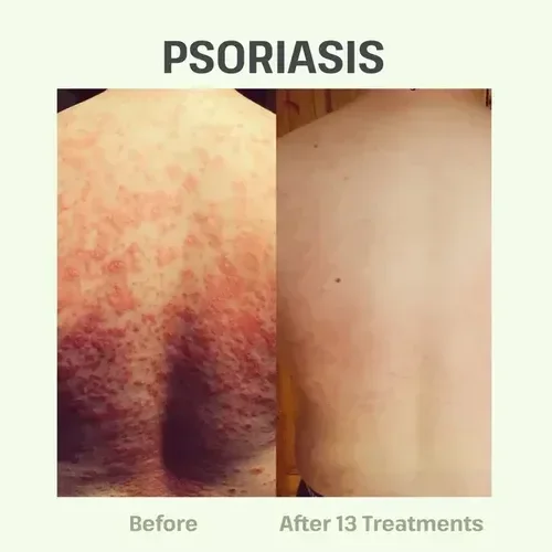 LED light therapy skin treatment for rejuvenation and healing at Sugarmoon® Salon in Canada