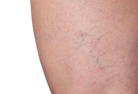 IPL treatment for vascular lesions reducing redness and visible veins at Sugarmoon® Salon in Canada
