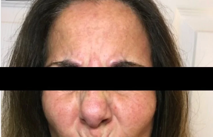 Before Frown Lines and Forehead