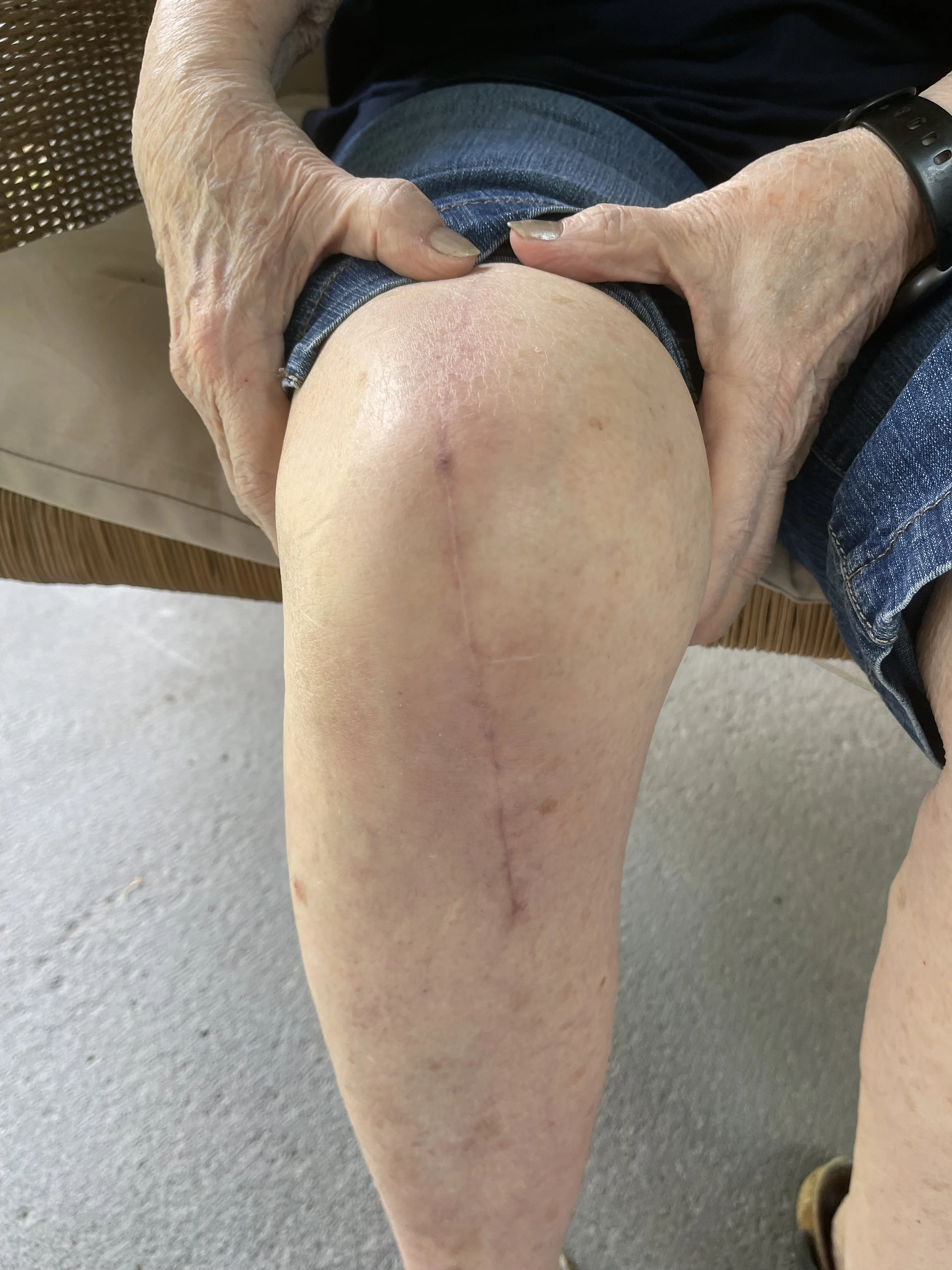 Picture of knee scar