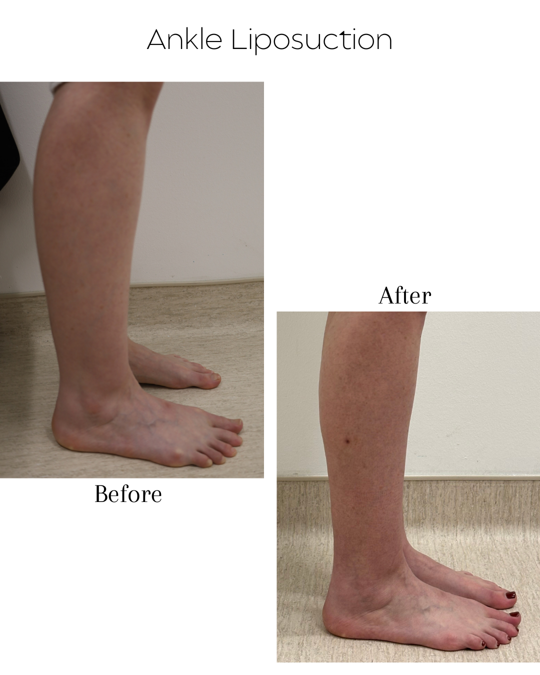 Ankle Liposuction 2.png