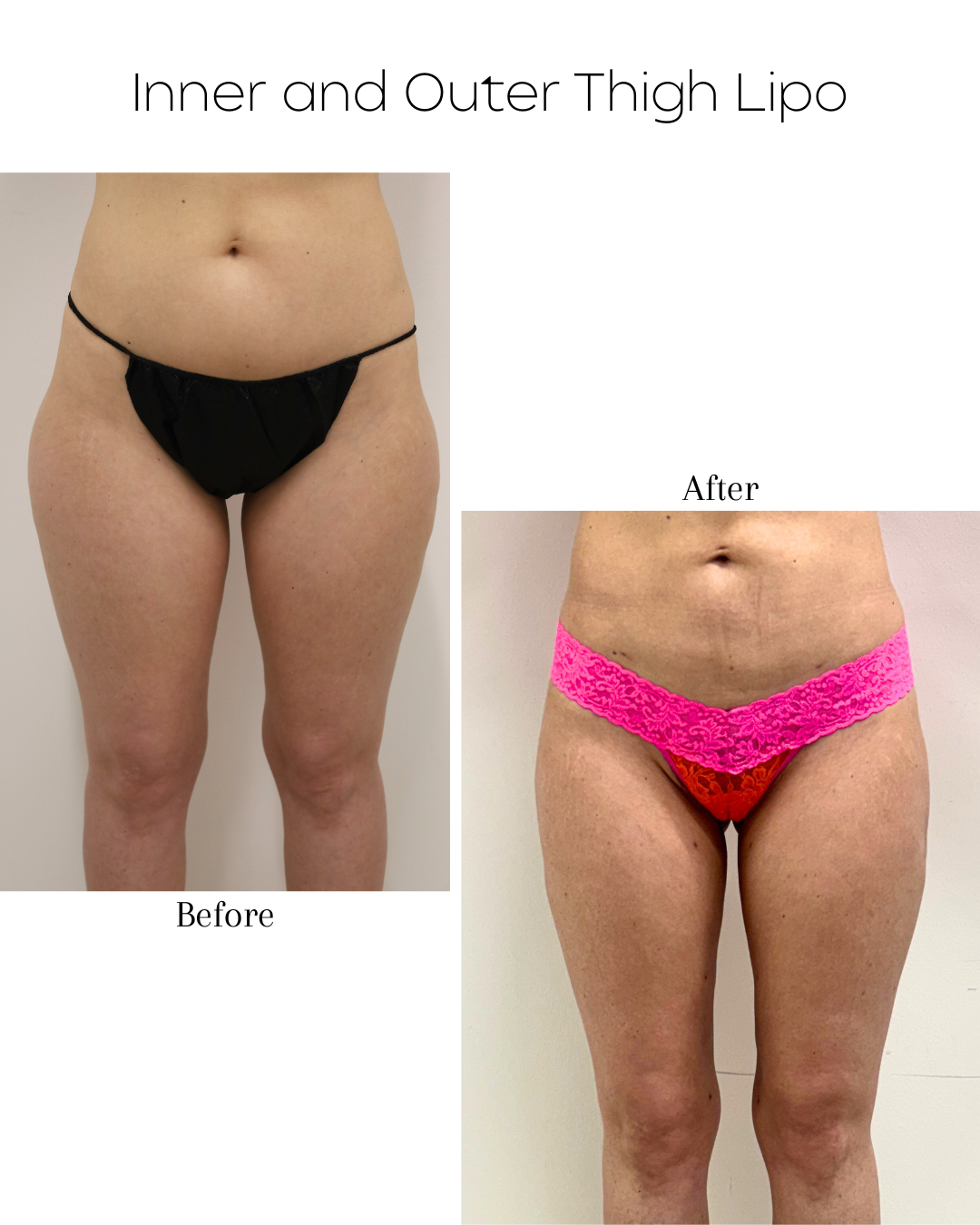 Inner and outer Thigh Lipo.png