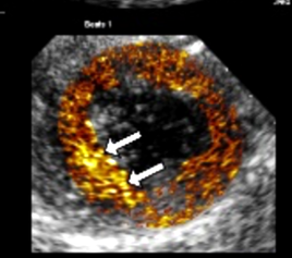 Activated Droplets: Infarct zone imaging