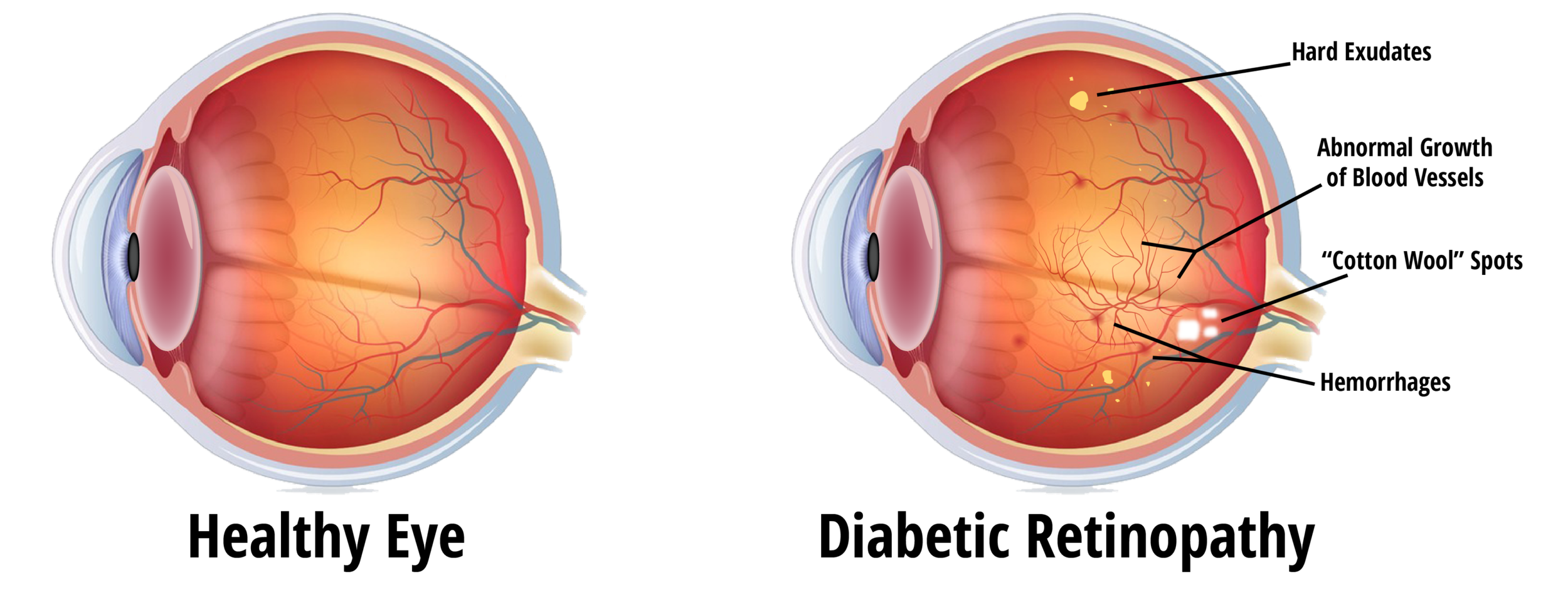 Diagram showing normal retina on the left and diabetic retinopathy on the right with blood vessel damage, microaneurysms, and hemorrhages.