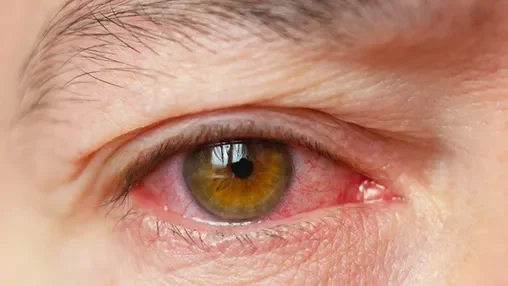 close up of a red, injected, dry eye