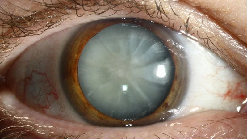 Close-up of human eye showing hazel iris and cloudy lens indicating cataract.