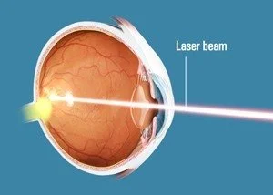Diagram of a laser beam targeting the retina inside the eye.