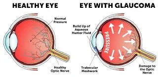 Diagram comparing a healthy eye to an eye with glaucoma, showing normal pressure and structure versus increased pressure and damage to eye tissues.