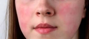 Histamine Isn’t the Problem - Your Clearance Is