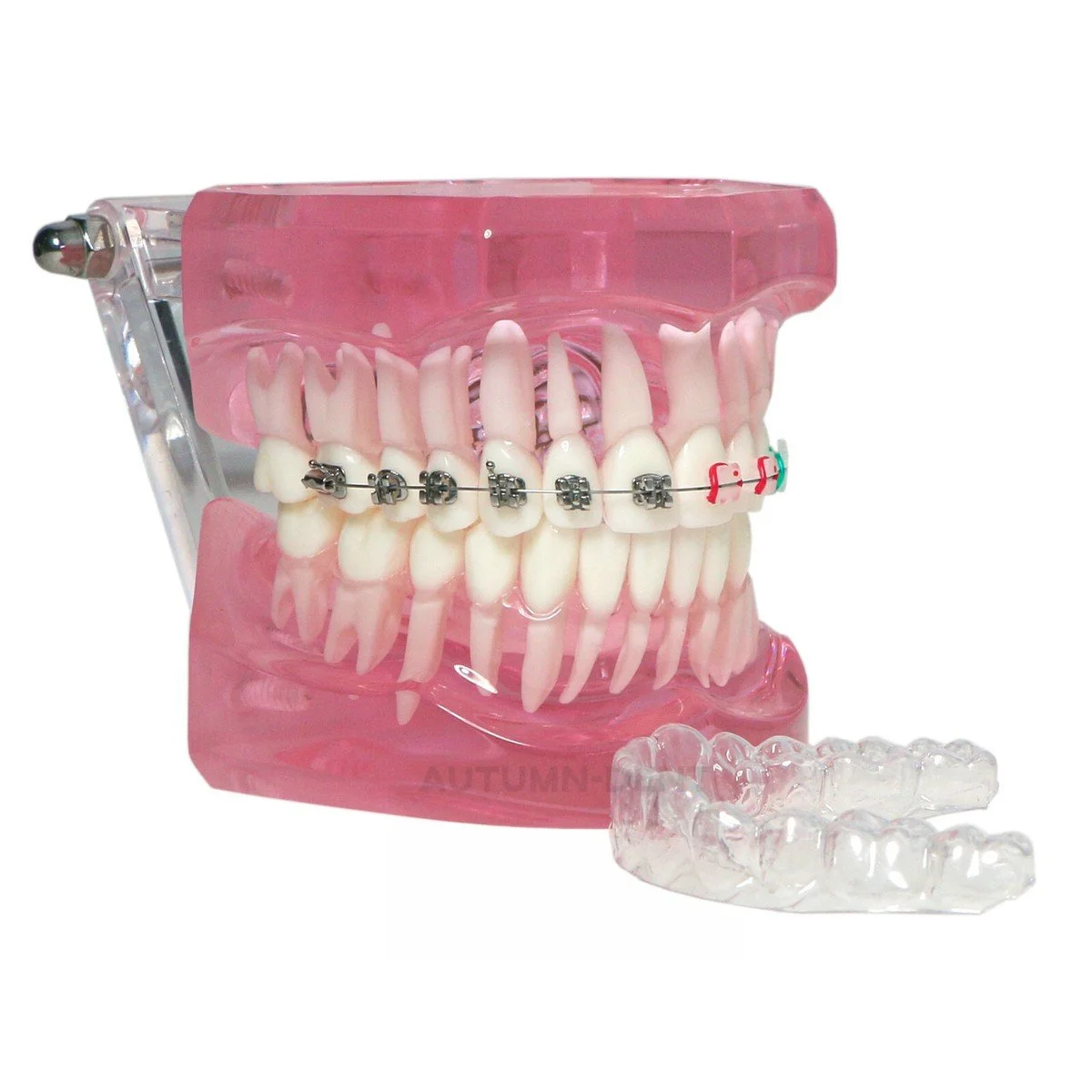 Dental model with braces and a clear aligner in front.