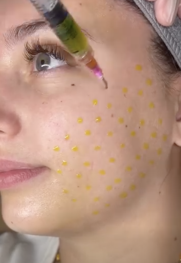 Close-up of a person receiving a BioRePeel chemical peel treatment on their face, with yellow dots marked on their cheek for the procedure.