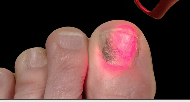 Close-up of a toenail being examined with a red light device, with the nail appearing discolored.
