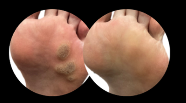 Comparison image showing a foot with plantar warts before and after treatment, with the warts removed in the second image.