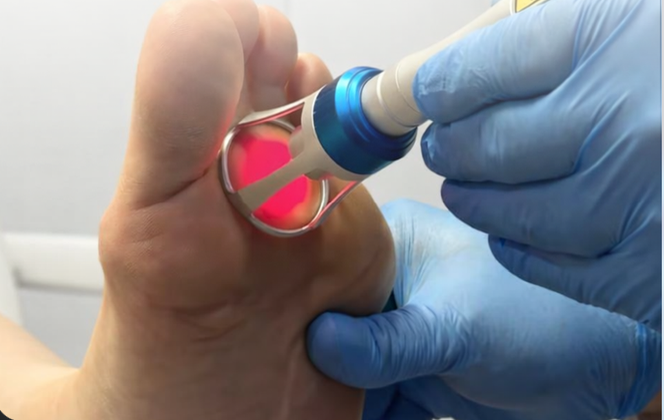 A medical professional using a laser device on a patient's toe with pink laser emission visible, wearing blue gloves.