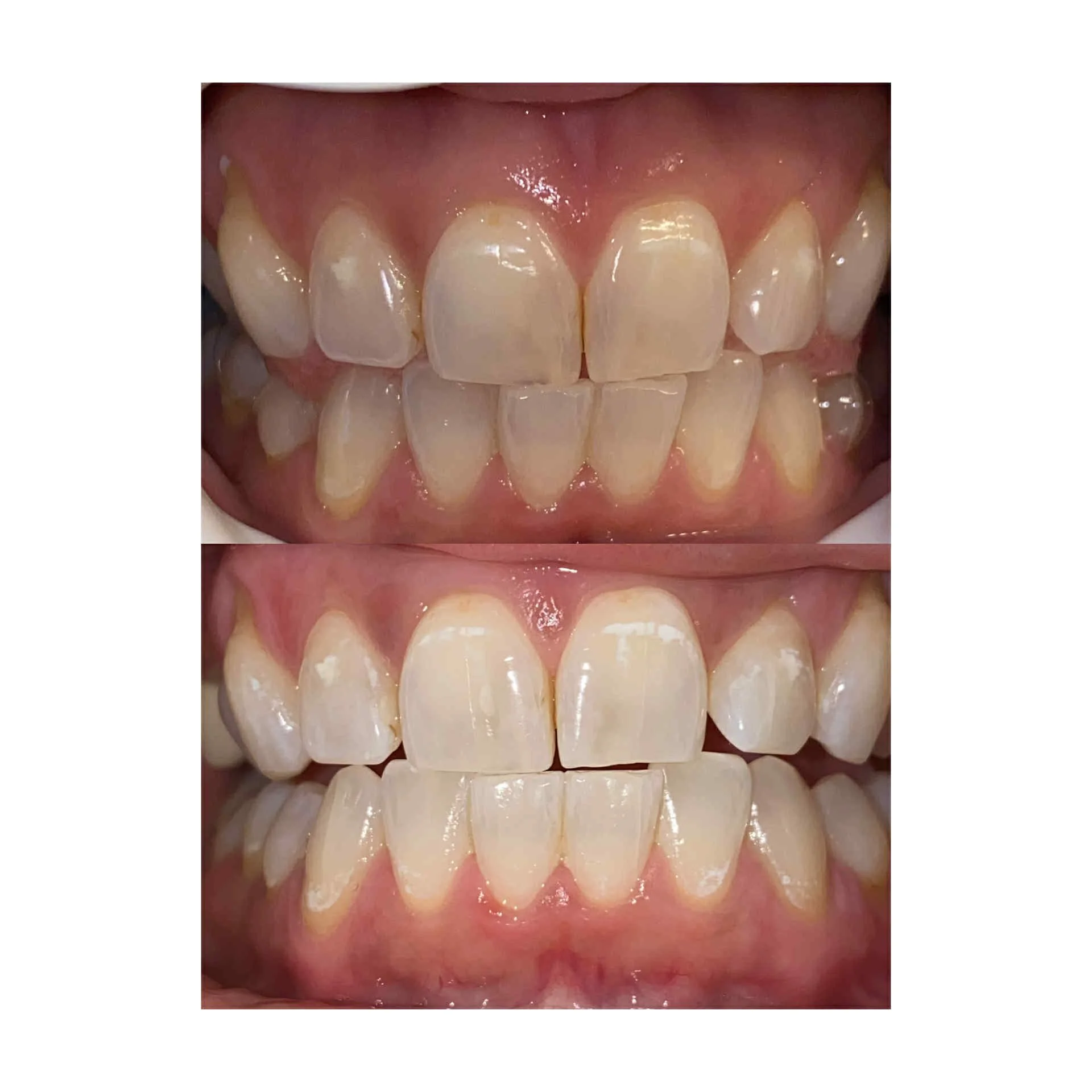 Comparison of teeth before and after dental treatment, showing improvements in tooth appearance and alignment.