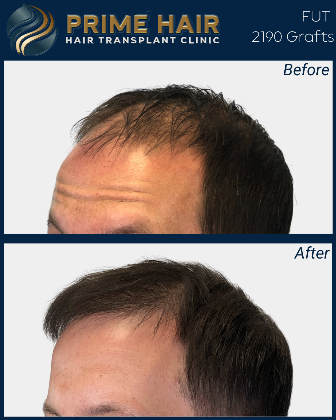 Comparison of a man's hair before and after hair transplant surgery, showing increased hair density and coverage in the 'After' image.
