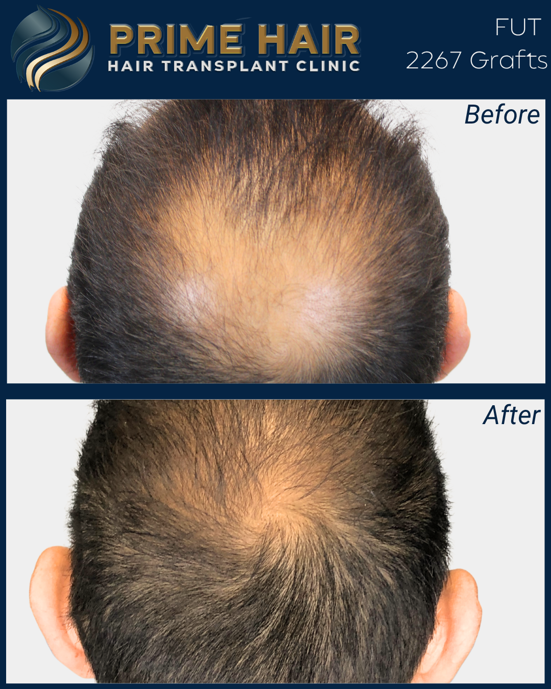 Comparison of a man's scalp before and after hair transplant surgery, showing increased hair density and coverage at the top of the head.