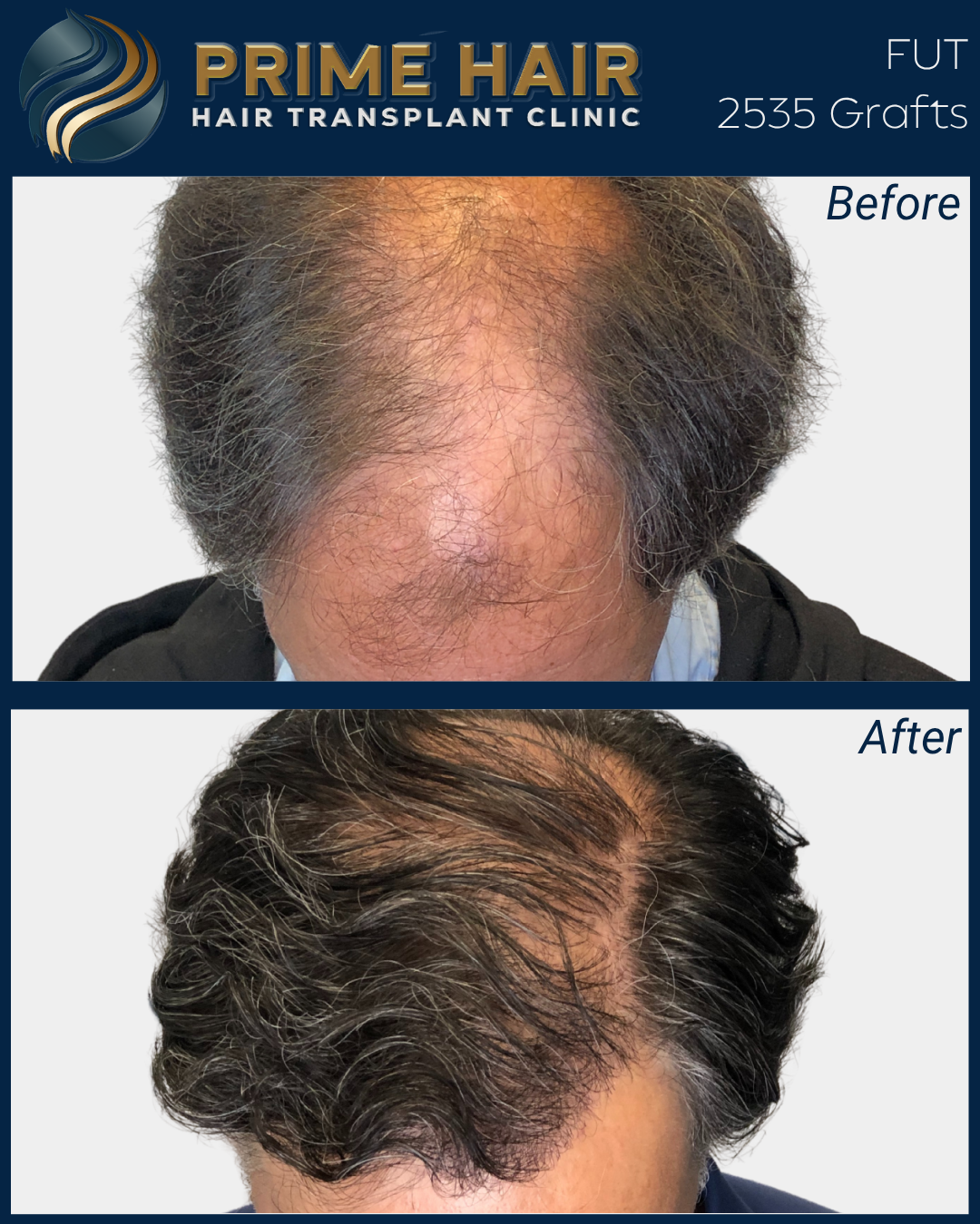 Before and after images of a man's scalp showing hair restoration results from Prime Hair Hair Transplant Clinic. The top image shows a bald, thinning scalp, and the bottom image shows a fuller head of hair after a transplant.
