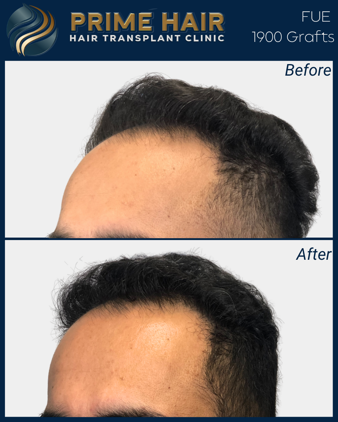 Before and after photos of a man's hair transplant. The top image shows thinning hair at the front, and the bottom image shows fuller, thicker hair after the procedure.