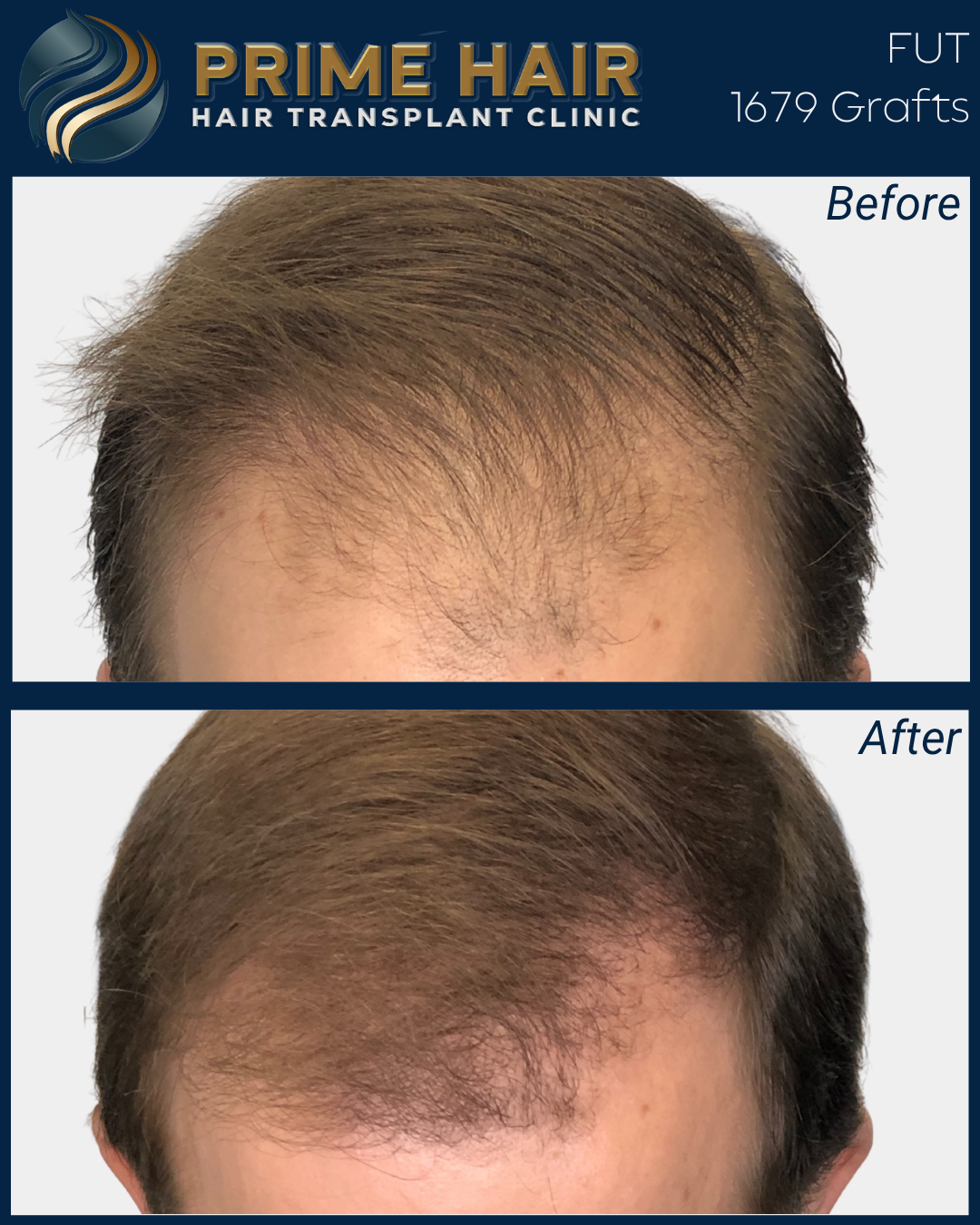 Comparison of a person's scalp before and after hair transplant at Prime Hair Clinic, showing increased hair density and coverage.