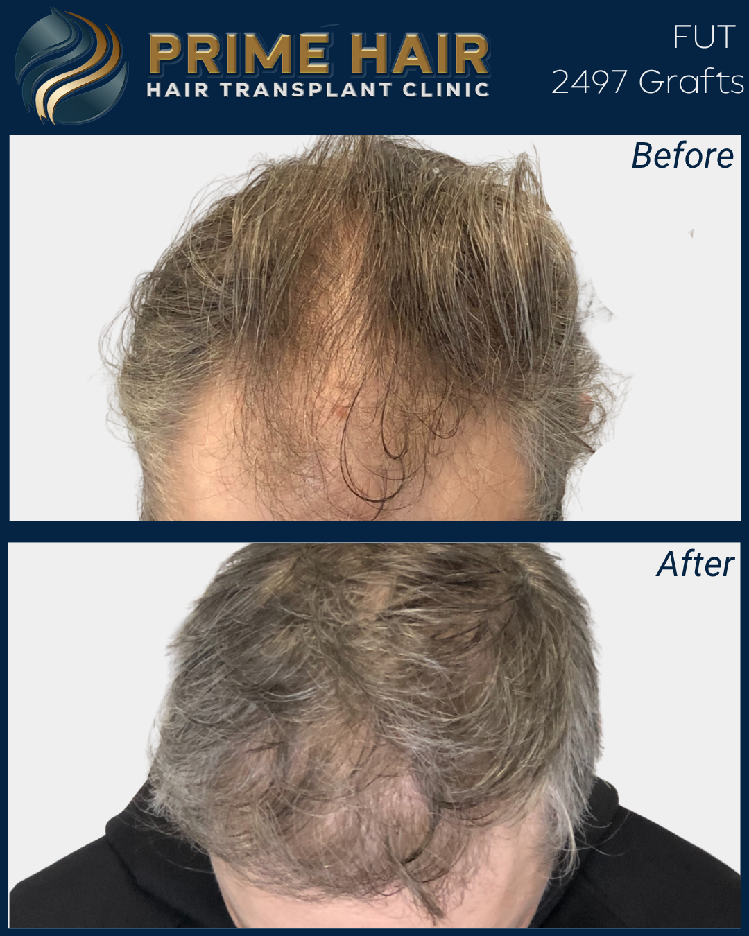 Before and after images showing improved hair density and coverage after hair transplant at Prime Hair Hair Transplant Clinic.