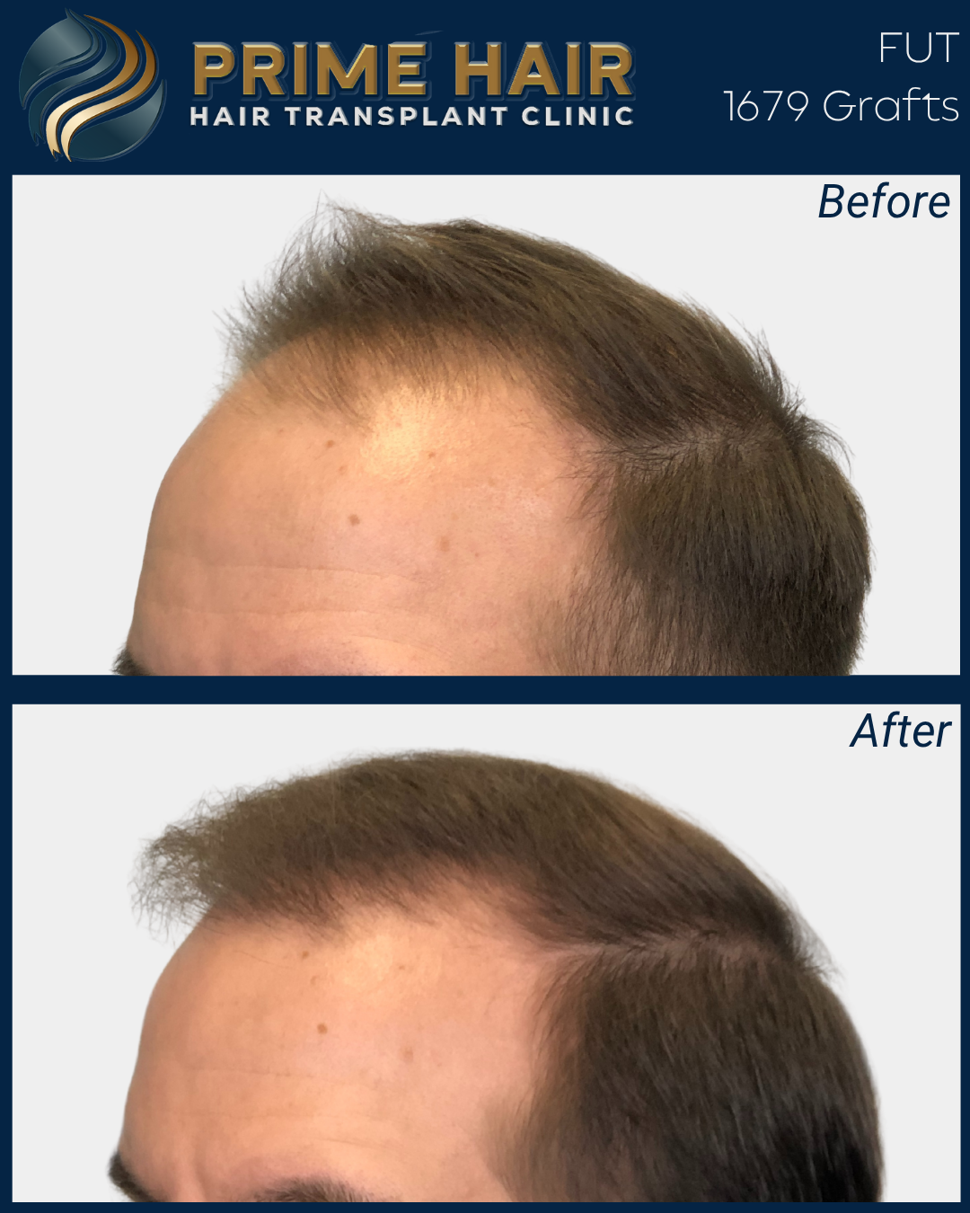 Side-by-side comparison of a man's hairline before and after a hair transplant, showing increased hair density and a restored hairline after the procedure.