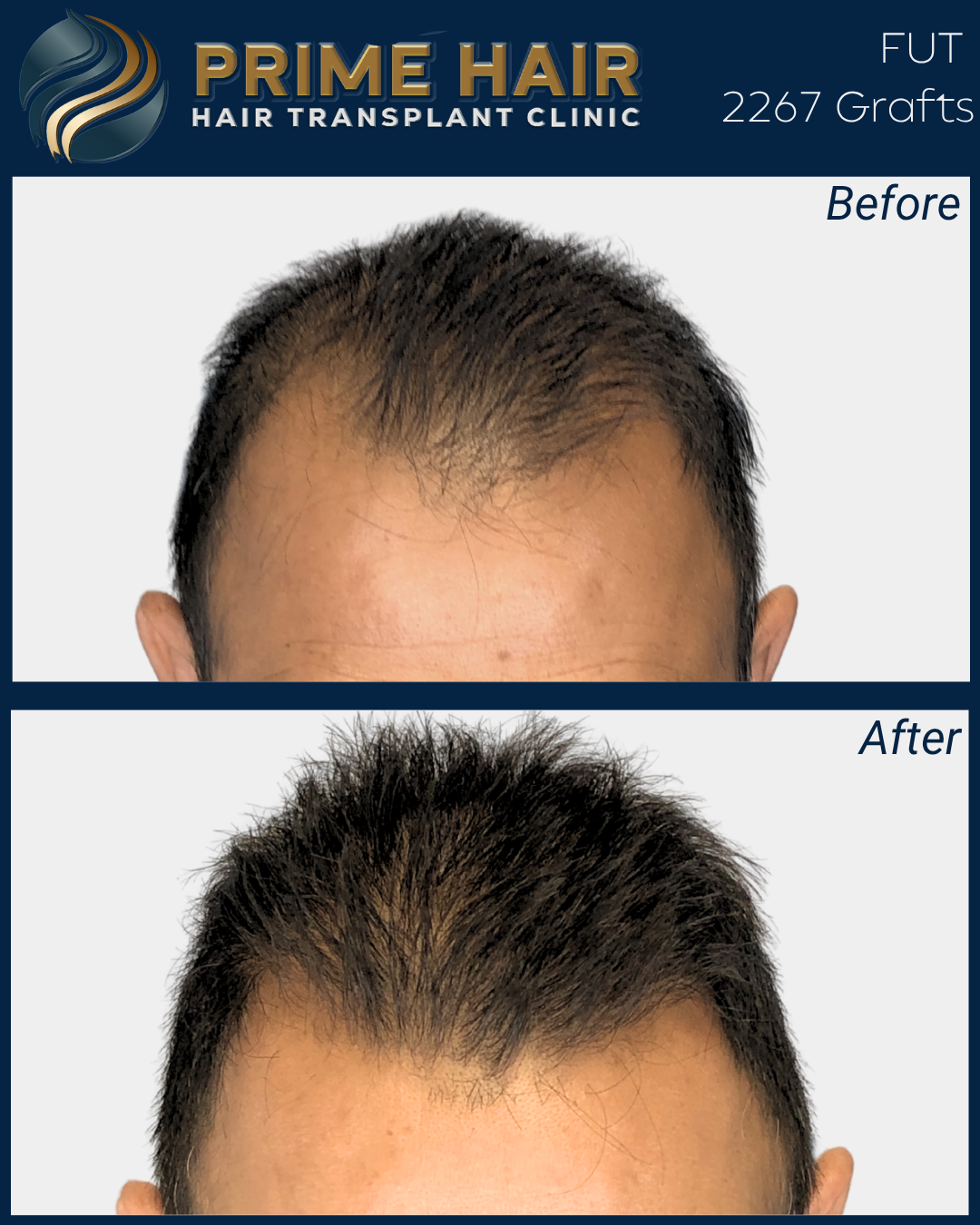 Comparison of a man's hair before and after hair transplant procedure at Prime Hair Hair Transplant Clinic. The 'Before' image shows thinning hair on top, and the 'After' image shows fuller, thicker hair.