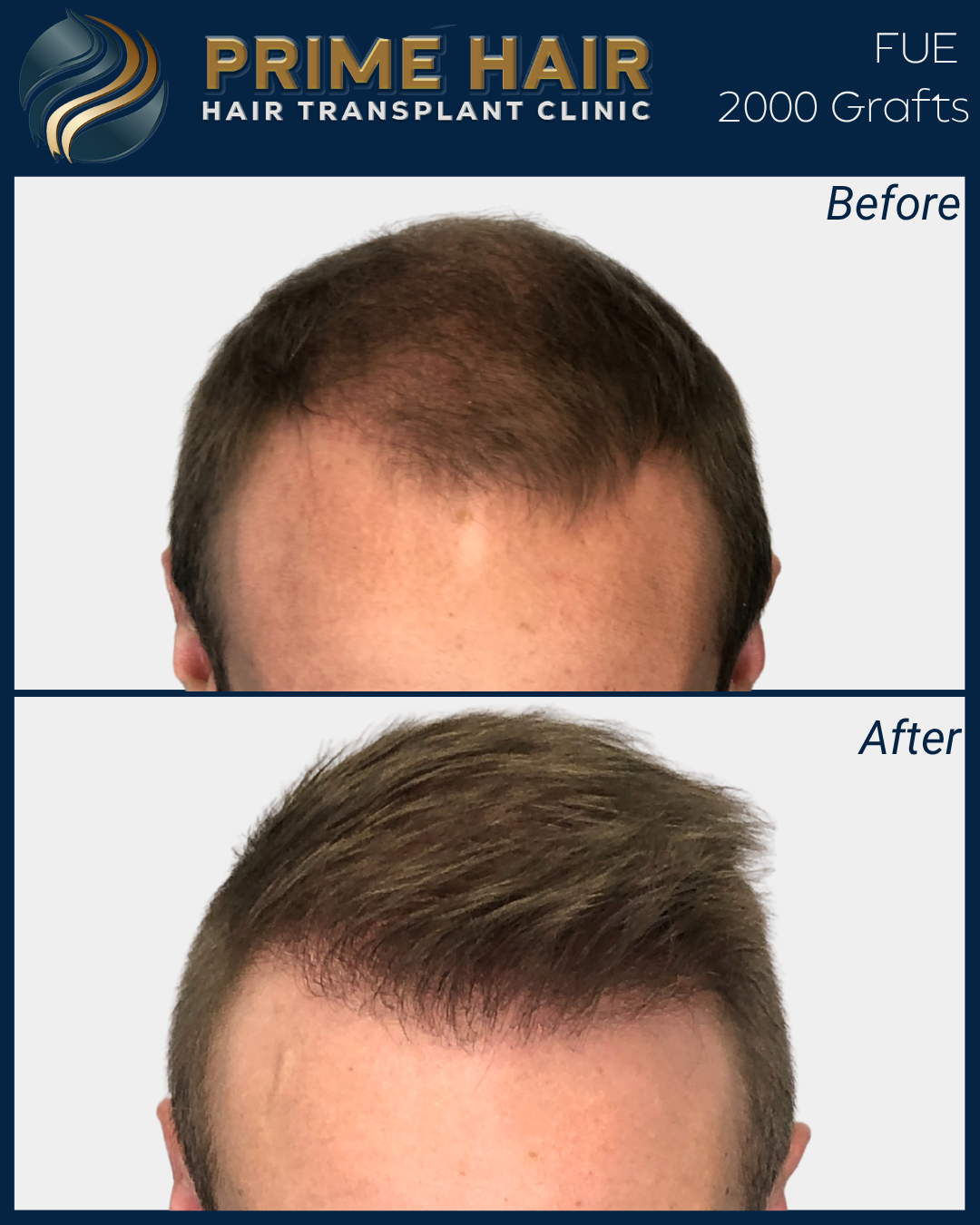 Before and after images of a person's hair showing a hair transplant. The top image displays thinning hair, while the bottom image shows fuller, thicker hair after the procedure. The image is from Prime Hair Hair Transplant Clinic.