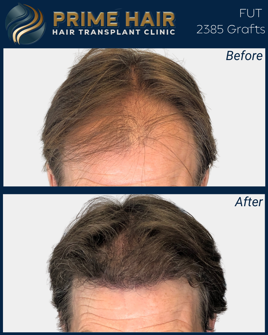 Before and after images showing hair restoration results from Prime Hair Hair Transplant Clinic, with the top image displaying thin hair and the bottom image showing fuller hair after treatment.