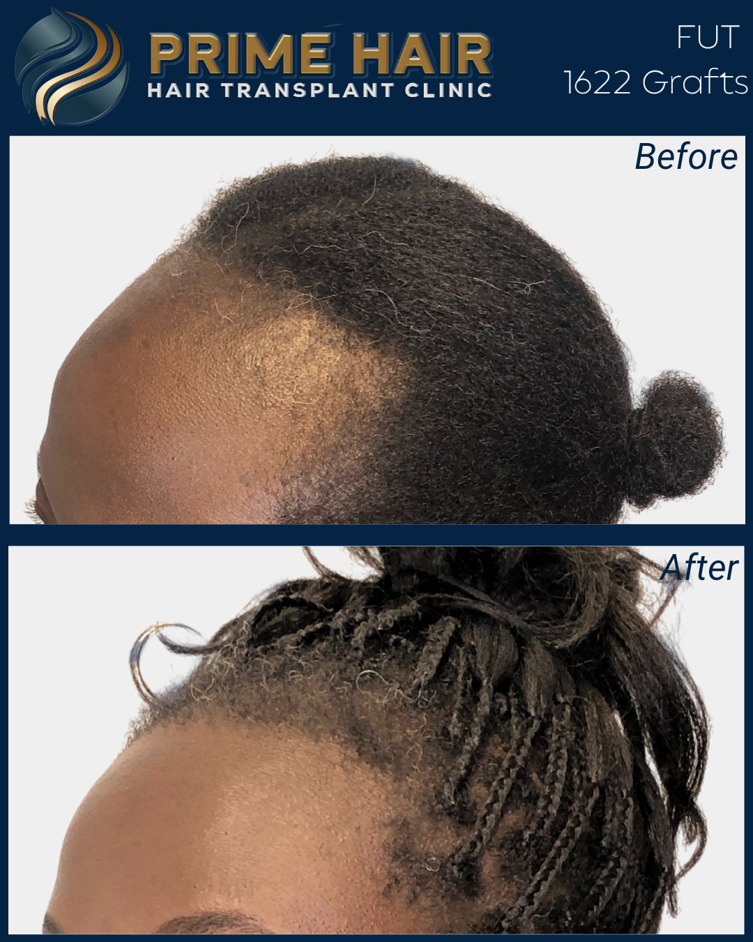 Before and after images showing hair restoration through grafts at Prime Hair Hair Transplant Clinic, with the 'before' image depicting a person with thinning hair and the 'after' image showing a person with styled, textured hair after the procedure.