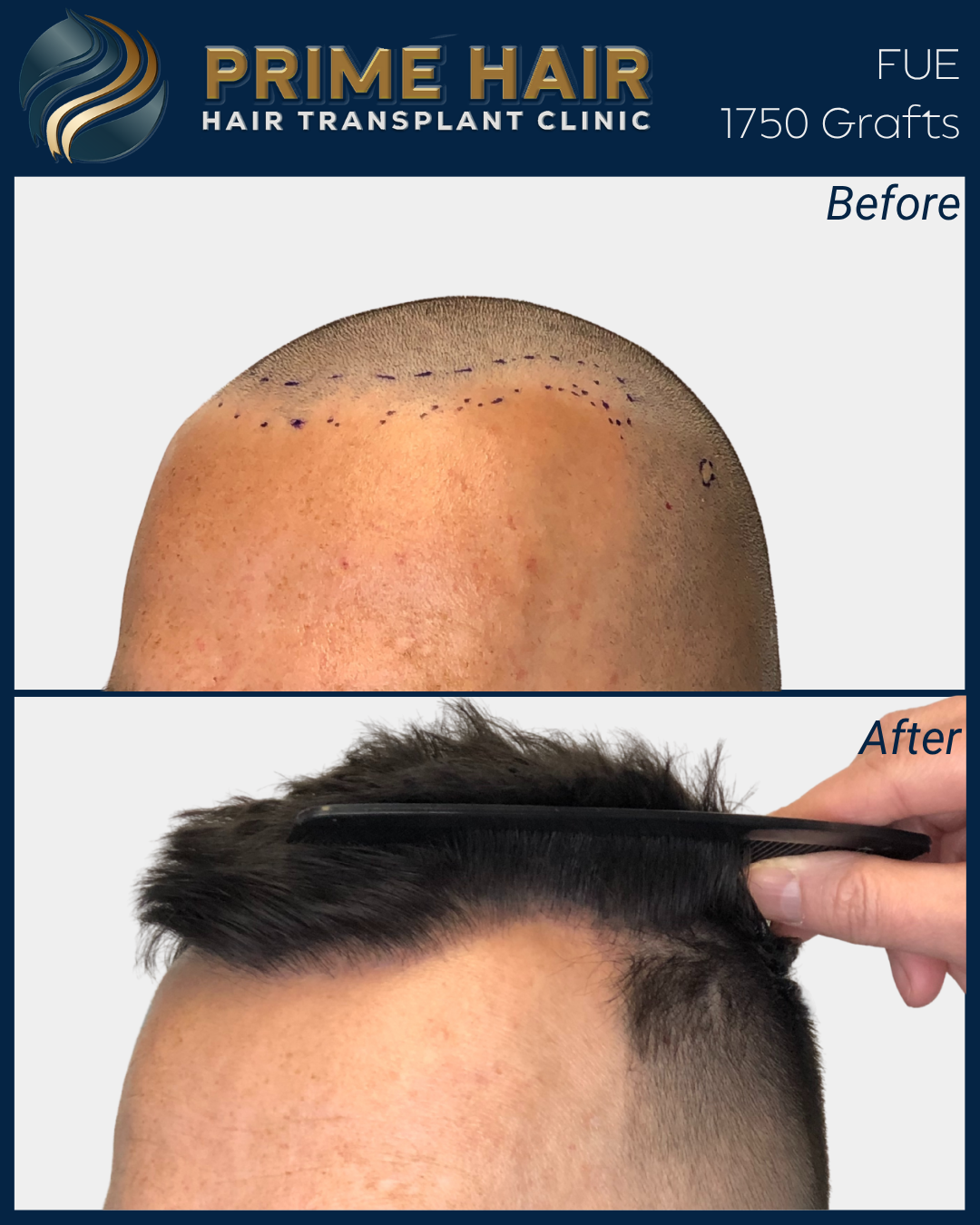 Before and after images of a hair transplant procedure showing the top of a man's head with the before image displaying a bald scalp with markings for transplantation, and the after image showing a full head of styled hair.