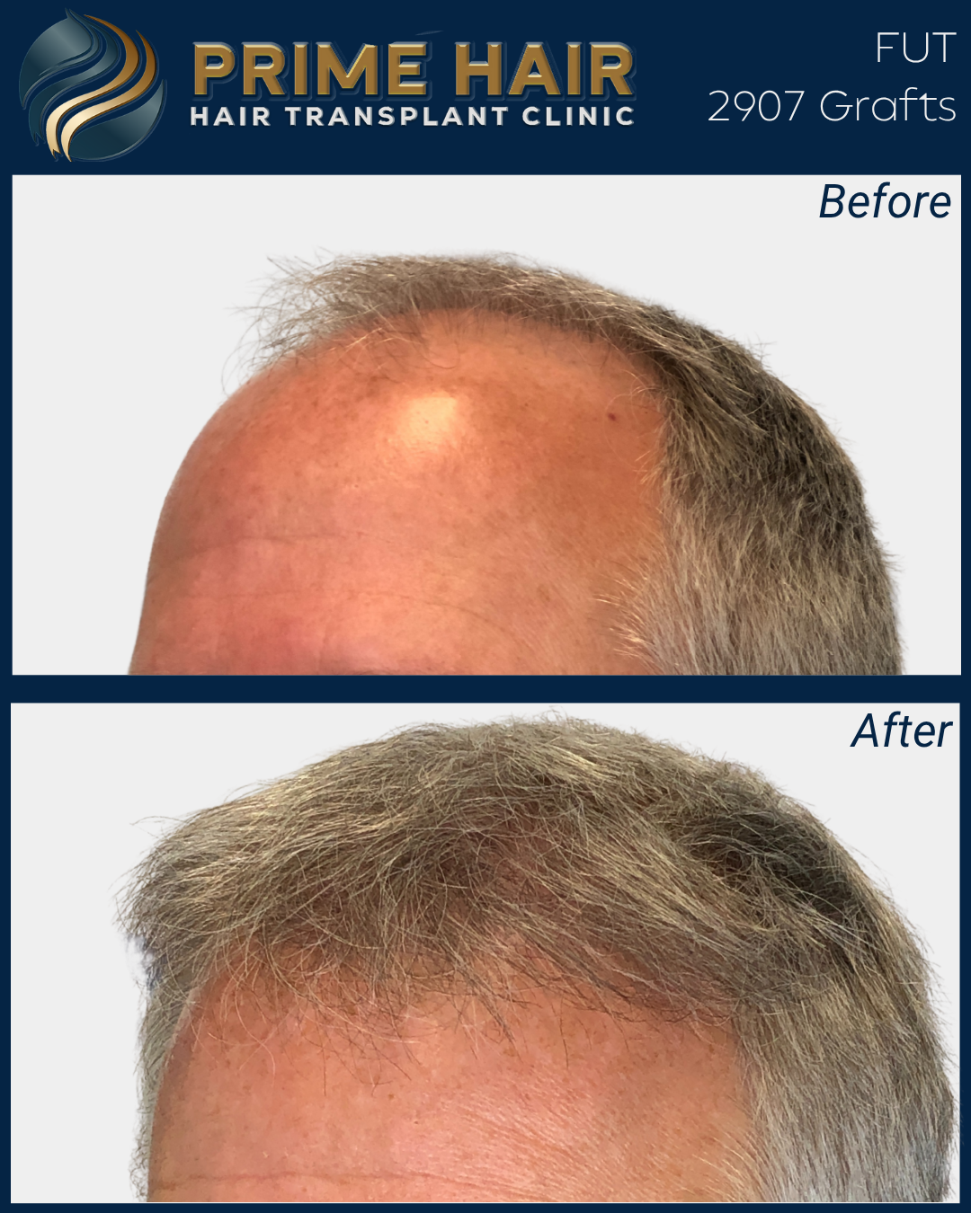 Before and after images showing a man's scalp, illustrating hair restoration through transplant, with the top image labeled 'Before' showing thinning hair and the lower image labeled 'After' showing fuller hair with more density.