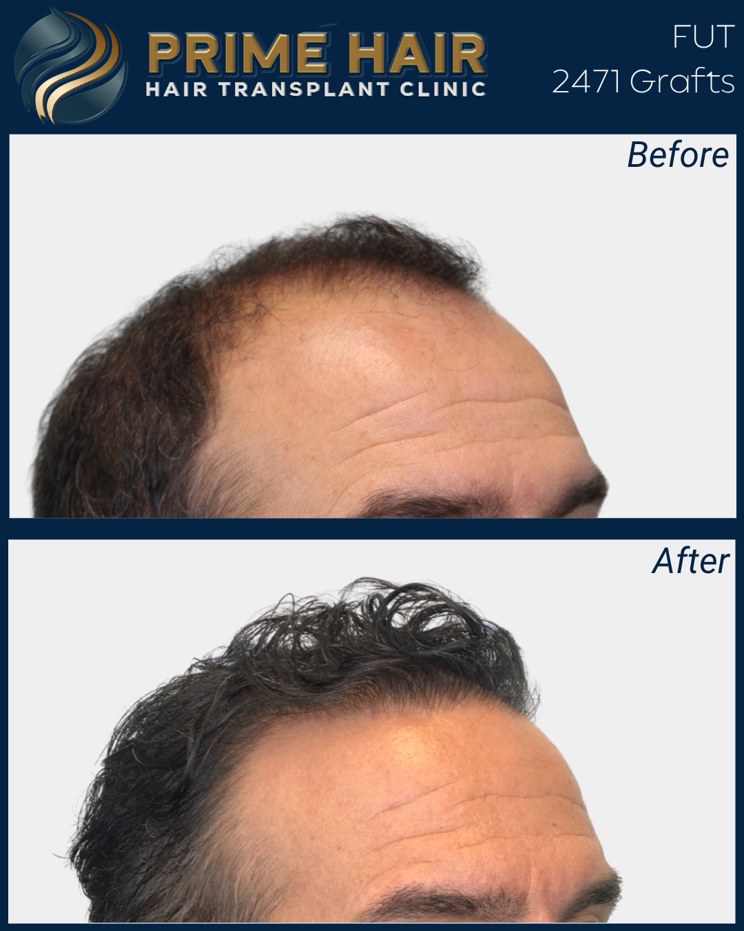 Before and after images showing a man's hair transformation through hair transplant; the top image shows thinning hair, and the bottom image shows fuller, styled hair after the procedure.