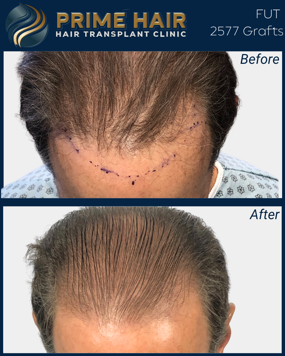 Before and after images showing hair restoration results from Prime Hair Hair Transplant Clinic. The top image shows a patient with marked hairline for transplantation, and the bottom image shows a fuller hairline after the procedure.