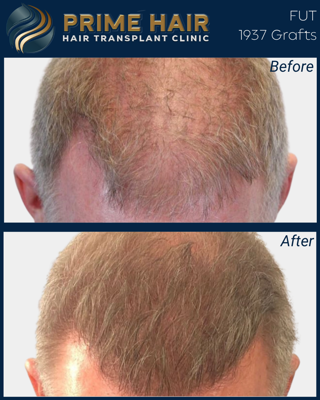 Before and after images showing the top of a person's head, highlighting the results of a hair transplant. The 'before' image shows significant hair loss and thinning, while the 'after' image shows fuller, thicker hair after the procedure.