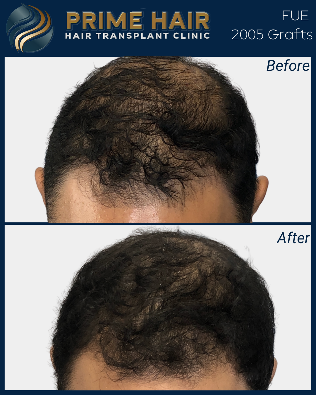 Before and after photos of hair transplant at Prime Hair Clinic showing improved hair density on top of the head.