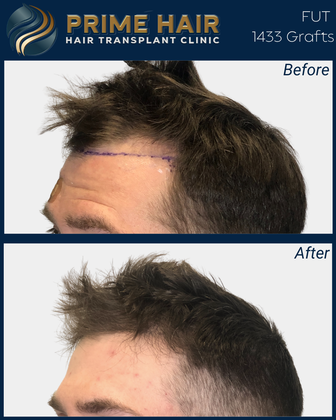 Before and after photos showing the results of a hair transplant at Prime Hair Hair Transplant Clinic, with the before image displaying a receding hairline marked with purple ink, and the after image showing fuller, denser hair.