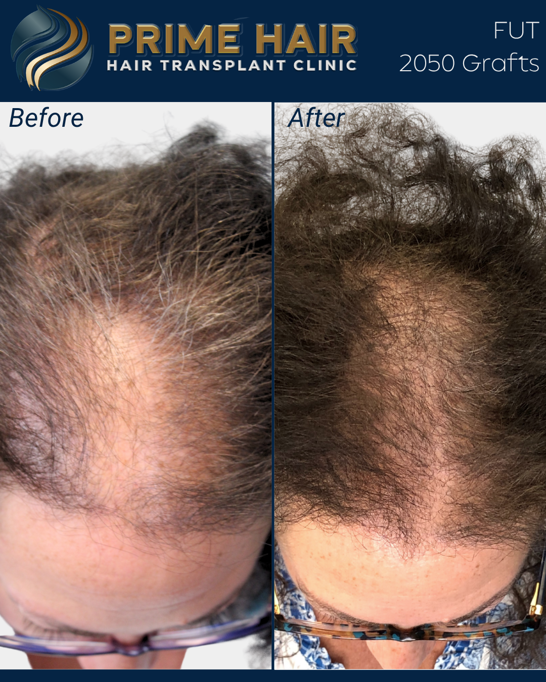 Side-by-side comparison of a person's scalp before and after hair transplantation, showing increased hair density in the after image.