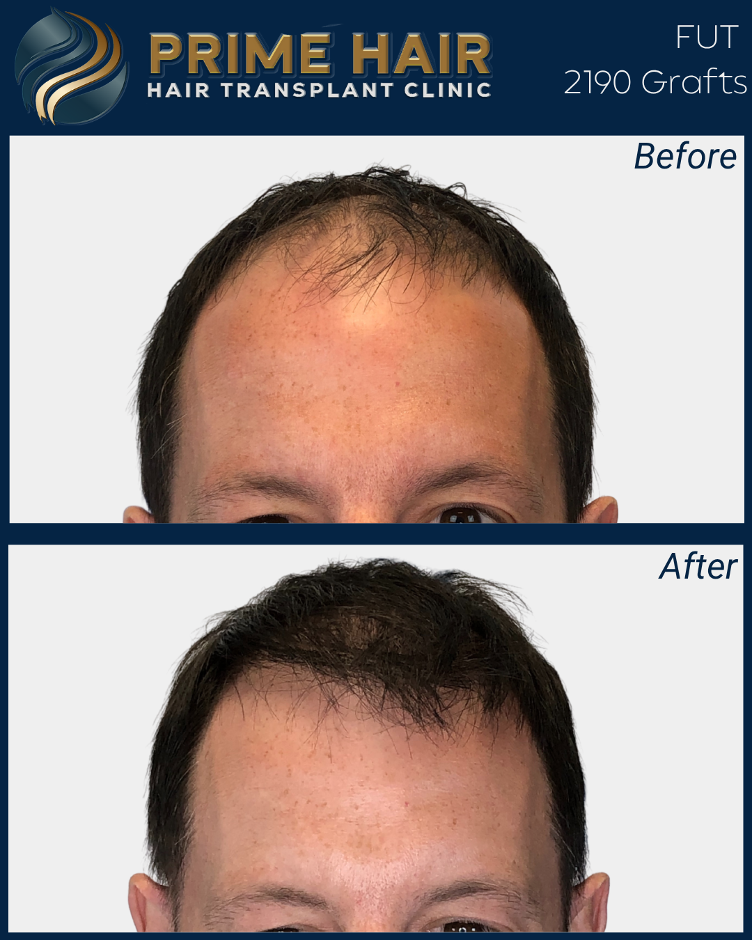 Comparison of a man's hair before and after a hair transplant procedure at Prime Hair Hair Transplant Clinic, showing increased hair density.