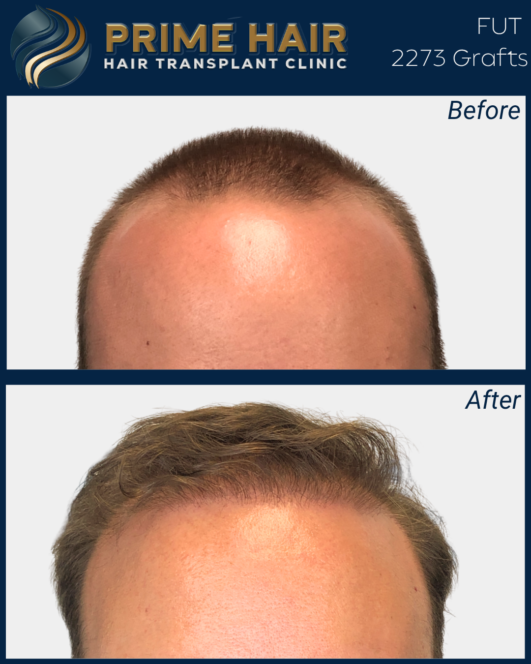 Before and after photos of a man's hairline showing results from hair transplantation, with the before image depicting a receding hairline and the after image showing fuller, thicker hair.
