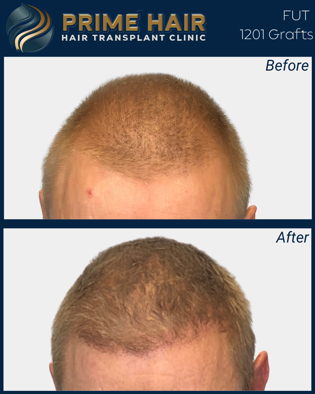 Before and after images of a man's hair transplant at Prime Hair Hair Transplant Clinic showing increased hair density and hairline restoration.